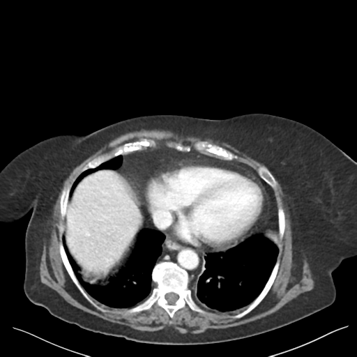 Cannonball metastases from endometrial cancer (Radiopaedia 42003-45031 E 9).png