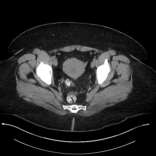 Carcinoid tumor - terminal ileum (Radiopaedia 60931-68740 Axial non-contrast 110).jpg