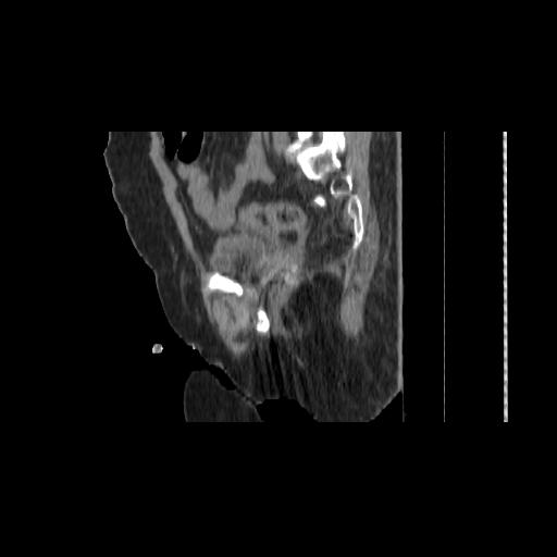 File:Carcinoma cervix- brachytherapy applicator (Radiopaedia 33135-34173 D 120).jpg