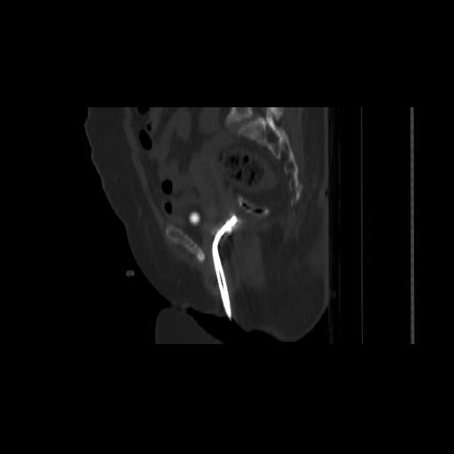 Carcinoma cervix- brachytherapy applicator (Radiopaedia 33135-34173 Sagittal bone window 76).jpg