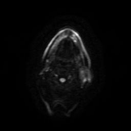 Carcinoma ex-pleomorphic adenoma of parotid (Radiopaedia 28383-28627 Ax DWI B-500 GE 48).jpg