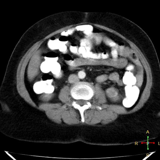 File:Carcinoma of sigmoid colon (Radiopaedia 23071-23100 C+ arterial phase 13).jpg