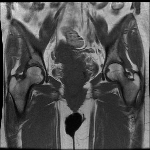 File:Carcinoma of the cervix (Radiopaedia 89018-105858 Coronal T1 8).jpg