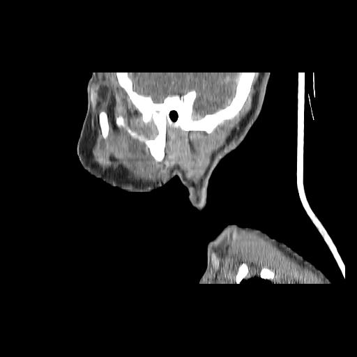 Carcinoma of the maxillary antrum (Radiopaedia 53805-59888 Sagittal C+ delayed 35).jpg