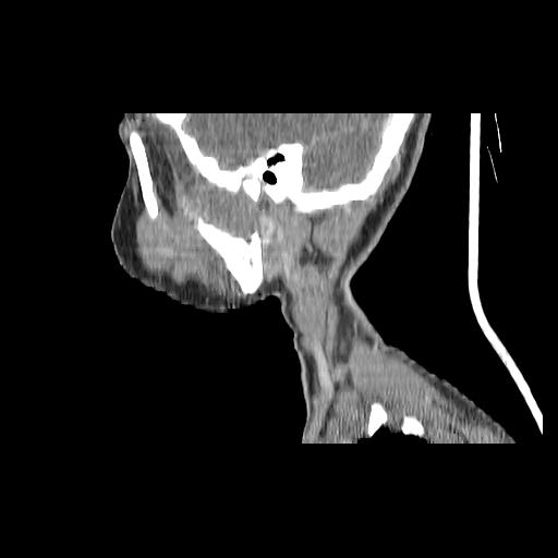 Carcinoma of the maxillary antrum (Radiopaedia 53805-59888 Sagittal C+ delayed 41).jpg