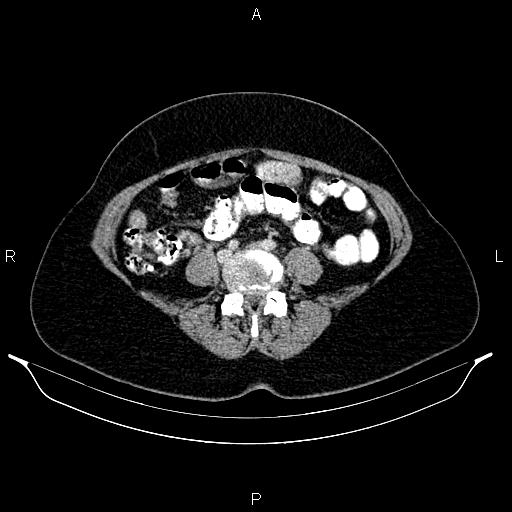 File:Carcinoma of uterine cervix (Radiopaedia 85861-101700 A 57).jpg