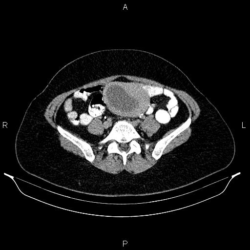 File:Carcinoma of uterine cervix (Radiopaedia 85861-101700 Axial C+ delayed 58).jpg