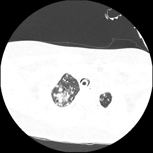 Cardiac angiosarcoma (Radiopaedia 66010-75181 Axial lung window 82).jpg