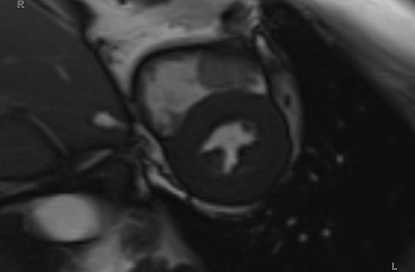 Cardiac hemangioma (Radiopaedia 31709-32631 Short axis Cine SSFP 15).jpg