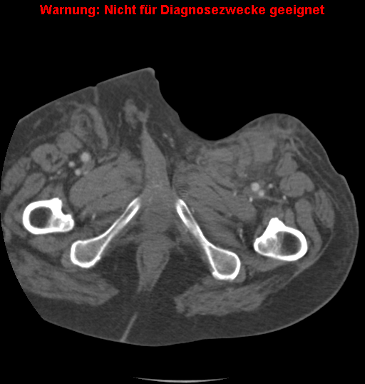 File:Cardiac perforation following transcatheter aortic valve implantation (Radiopaedia 23714-23863 B 18).png