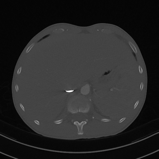 Cardiac tumor - undifferentiated pleomorphic sarcoma (Radiopaedia 45844-50134 Axial bone window 66).png