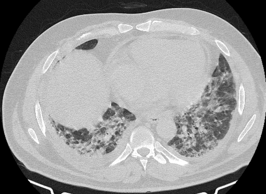 Cardiogenic pulmonary edema (Radiopaedia 68180-77678 Axial lung window 67).jpg