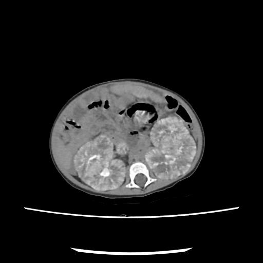 File:Caroli disease with autosomal recessive polycystic kidney disease (ARPKD) (Radiopaedia 89651-106703 E 114).jpg