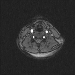 Carotid artery dissection (Radiopaedia 28441-28689 Axial MRA 34).jpg