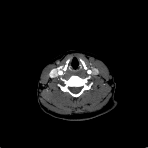 File:Carotid body tumor (Radiopaedia 39845-42300 B 9).jpg