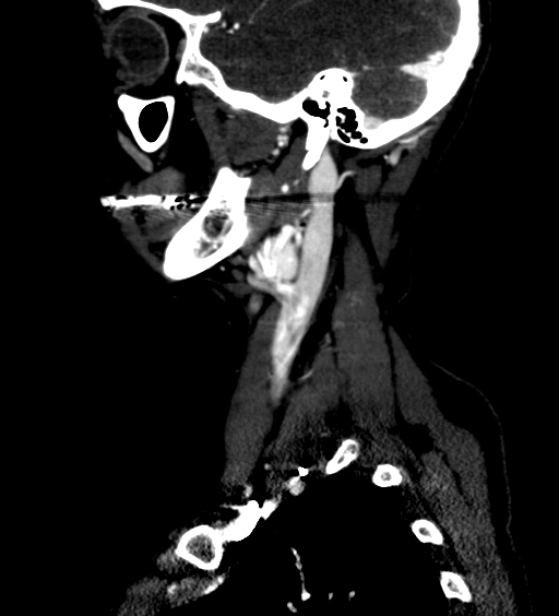 File:Carotid body tumor (Radiopaedia 39845-42300 D 6).jpg