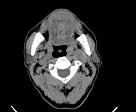 Carotid body tumor (Radiopaedia 61750-69757 Axial non-contrast 29).jpg