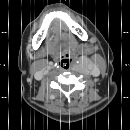 File:Carotid body tumor (paraganglioma) (Radiopaedia 38586-40729 C 1).jpg