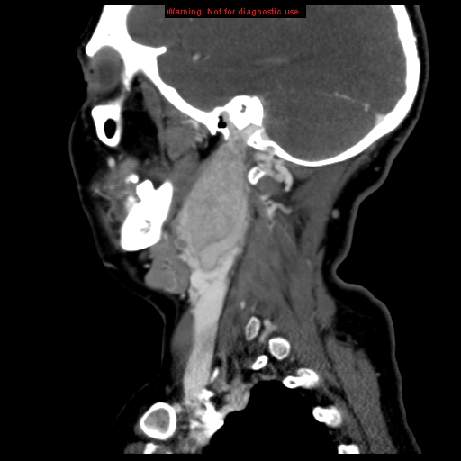 Carotid body tumor with lung metastases (Radiopaedia 9301-9986 Sagittal C+ delayed 38).jpg
