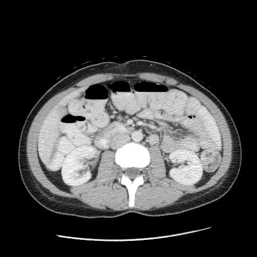 Castleman disease with fibrous pseudotumor in the abdomen (Radiopaedia 77296-89373 A 58).jpg