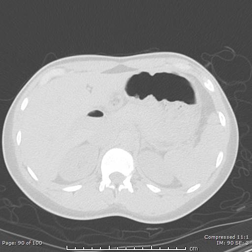 Catamenial pneumothorax (Radiopaedia 54382-60600 Axial non-contrast 90).jpg