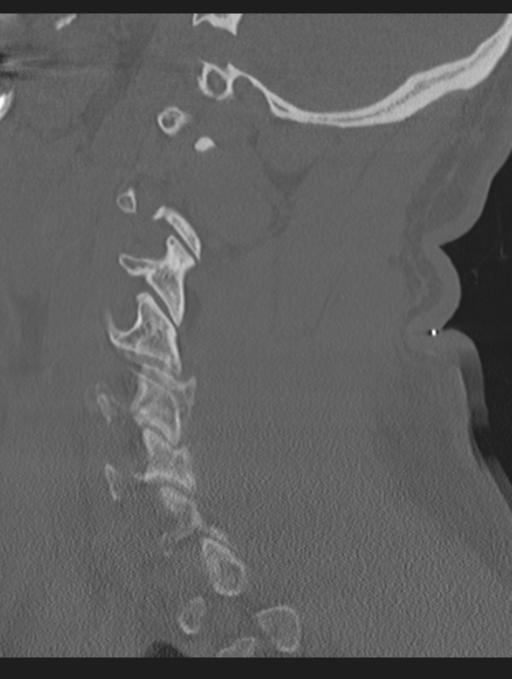 Cavernoma of cervical cord (Radiopaedia 50838-56346 Sagittal bone window 58).png