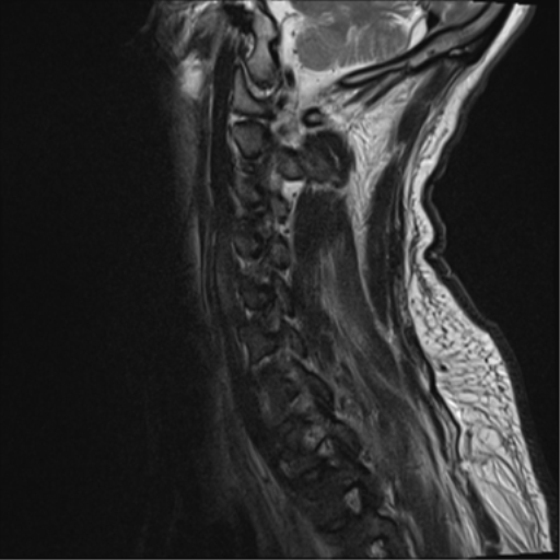 File:Cavernoma of cervical cord (Radiopaedia 50838-56347 C 4).png