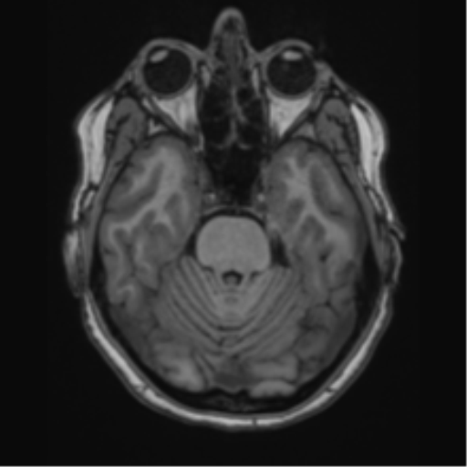 Cavernoma with bleed - midbrain (Radiopaedia 54546-60774 Axial T1 7).png