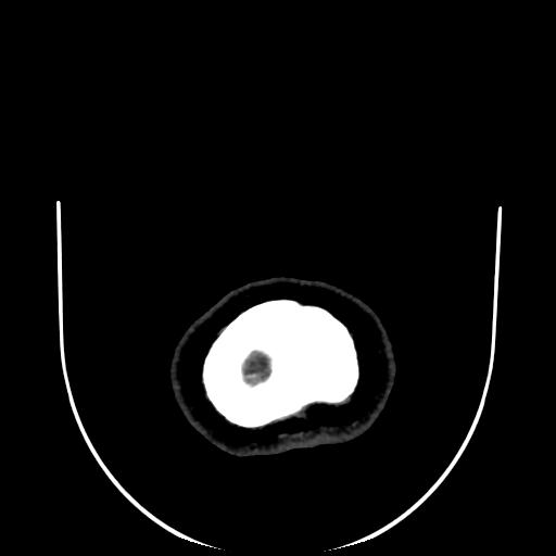 Cavernoma with developmental venous anomaly (Radiopaedia 22470-22506 C 204).jpg