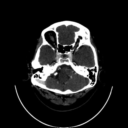 Cavernoma with developmental venous anomaly (Radiopaedia 22470-22506 C 23).jpg