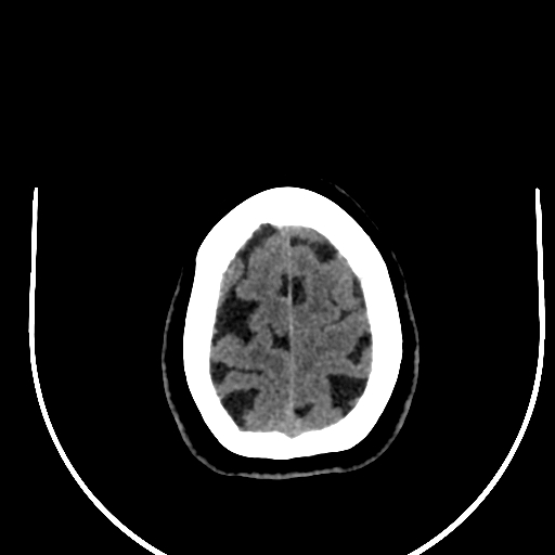 Cavernous hemangioma of the cerebellar falx (Radiopaedia 73025-83723 Axial non-contrast 123).jpg