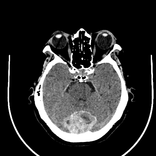 Cavernous hemangioma of the cerebellar falx (Radiopaedia 73025-83723 Axial non-contrast 43).jpg