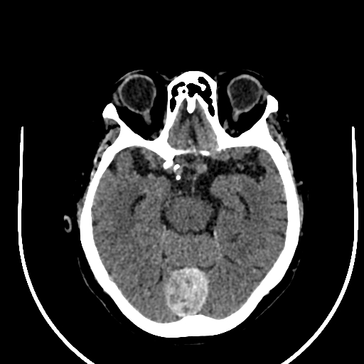 Cavernous hemangioma of the cerebellar falx (Radiopaedia 73025-83723 Axial non-contrast 52).jpg
