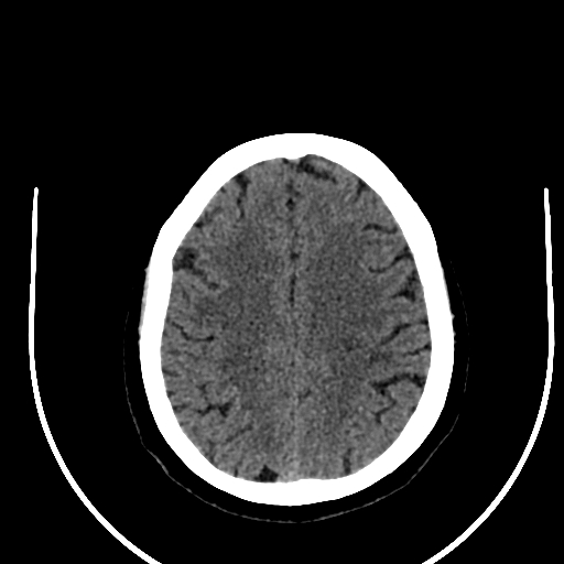 Cavernous hemangioma of the cerebellar falx (Radiopaedia 73025-83723 Axial non-contrast 99).jpg