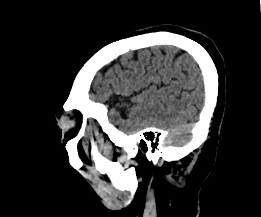 Cavernous hemangioma of the cerebellar falx (Radiopaedia 73025-83723 B 268).jpg