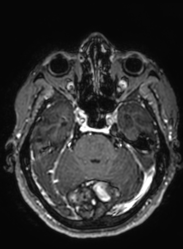 File:Cavernous hemangioma of the cerebellar falx (Radiopaedia 73025-83724 Axial T1 C+ 236).jpg