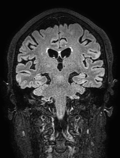 Cavernous hemangioma of the cerebellar falx (Radiopaedia 73025-83724 Coronal FLAIR 201).jpg