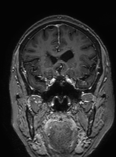 Cavernous hemangioma of the cerebellar falx (Radiopaedia 73025-83724 Coronal T1 C+ 128).jpg
