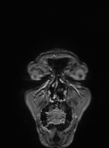 Cavernous hemangioma of the cerebellar falx (Radiopaedia 73025-83724 Coronal T1 C+ 8).jpg