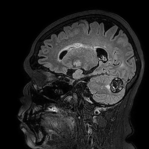Cavernous hemangioma of the cerebellar falx (Radiopaedia 73025-83724 Sagittal FLAIR 76).jpg
