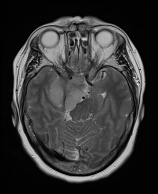 File:Cavernous sinus meningioma (Radiopaedia 63682-72367 Axial T2 9).jpg
