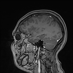 Cavernous sinus meningioma (Radiopaedia 63682-72367 Sagittal T1 C+ 123).jpg