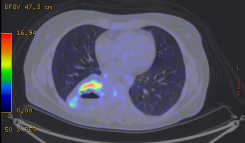 File:Cavitating lung mass - squamous cell carcinoma (Radiopaedia 48047-52853 A 57).png