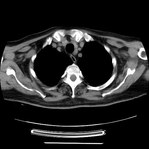 File:Cavitating pulmonary metastases (Radiopaedia 89545-106544 Axial non-contrast 8).jpg
