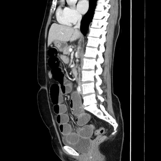 Cecal adenocarcinoma (Radiopaedia 75909-87331 C 37).jpg