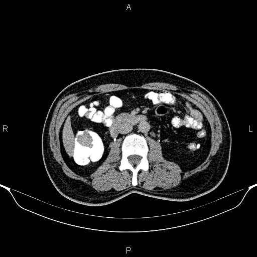 Cecal adenocarcinoma (Radiopaedia 85324-100916 Axial C+ delayed 46).jpg