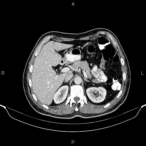 Cecal adenocarcinoma (Radiopaedia 85324-100916 B 25).jpg