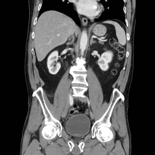 Cecal mass causing appendicitis (Radiopaedia 59207-66531 B 29).jpg