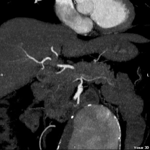 File:Celiac artery anatomy (Radiopaedia 16763-16476 A 5).jpg