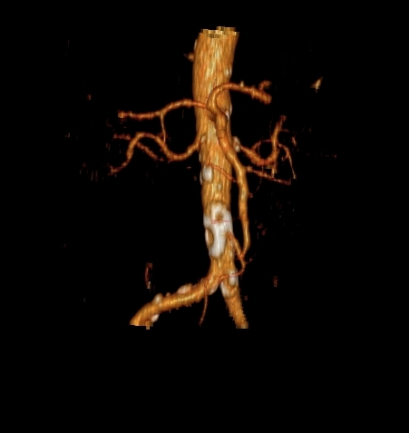 File:Celiacomesenteric trunk (Radiopaedia 67660-77071 VR C+ arterial phase 5).jpg